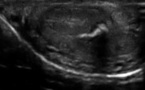maladie de lapeyronie echographie - maladie de lapeyronie dernière avancée