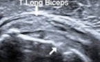 Rupture des fibres superficielles du tendon subscapulaire