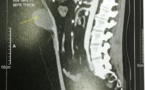 Complication de la chirurgie de la paroi abdominale