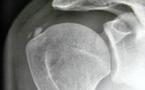 Migration d’une calcification dans la B.S.A.D