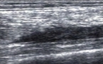 Cicatrice d'une Rupture Musculaire