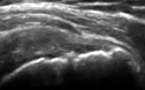 Rupture partielle du tendon supra-epineux