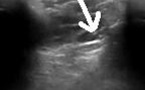 Echographie du L.C.A.E. par abord antérieur