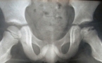 Maladie de Legg Calve Perthes