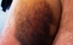 Rupture complète du tendon du long biceps