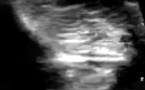 Le ligament tibio-fibulaire postéro-inférieur