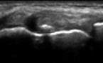 Rupture du faisceau superficiel du ligament collatéral médial du genou