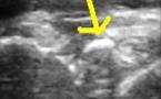 Calcification labrale