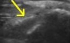 Calcification de l'enthèse distale du petit glutéal