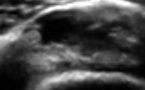 Rupture récente du versant superficiel du tendon supra-epineux