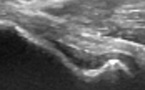 Le faisceau antérieur du ligament collatéral ulnaire