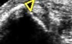 Le signe du fibrocartilage des tendons fibulaires