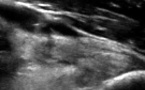 Rupture partielle du tendon distal du biceps brachial