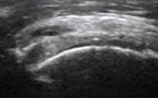Kyste du labrum acétabulaire