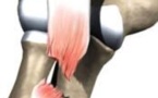 Rupture du tendon distal du biceps brachial