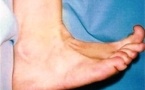 Thrombose étendue de la veine saphène externe