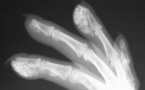Calcifications sous cutanées au niveau des doigts