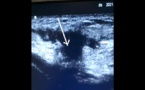 Rupture du tendon rotulien