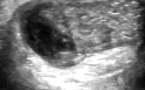 Rupture du tendon plantaire grêle