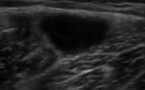 Désinsertion myo-aponévrotique du long biceps fémoral