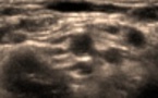 Le Lacertus Fibrosus