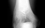 Processus supra-condylien et ligament de Struthers