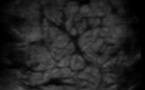 Lésion musculaire du sartorius