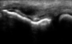 Rupture étendue sans rétraction du tendon commun des épicondyliens