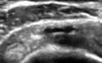 Rupture récente du versant superficiel du tendon supra-épineux