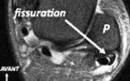 Fissuration longitudinale du tendon court fibulaire