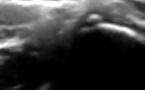 Lésion tendineuse aigue intrinsèque du tendon long adducteur