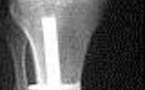 Complications d'un enclouage tibial centro-médullaire