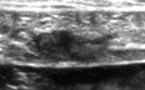 Lésion musculaire intrinsèque du grand droit abdominal