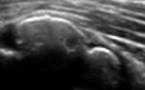Volumineuse calcification dans la B.S.A.D.