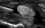 Infiltration d'une ténosynovite du tibial postérieur