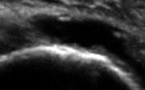 Rupture récente du tendon supra-épineux