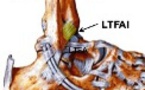 Repérage échographique du ligament tibio-fibulaire antéro-inférieur