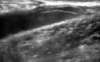 Ponction sous échoguidage d'un tennis leg