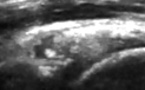Calcification labrale