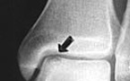Fracture du coin supéro-latéral du dôme du talus