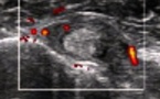 Ténosynovite et rupture partielle du tendon du long biceps