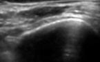 Traumatisme musculaire intrinsèque du vaste intermédiaire