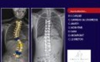 La scoliose: diagnostic et prise en charge