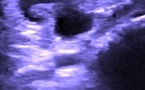 Rupture du tendon long extenseur du pouce