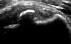 Calcification du tendon sub-scapulaire