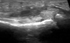 Plaie du tendon long fléchisseur du pouce