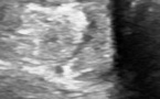 Fissuration du tendon court fibulaire