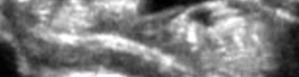 Muscle fléchisseur superficiel de l'index intracarpien