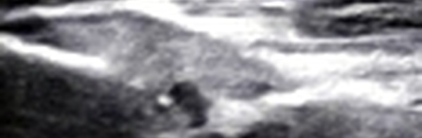 Desinsertion partielle du tendon direct du Rectus Fémori