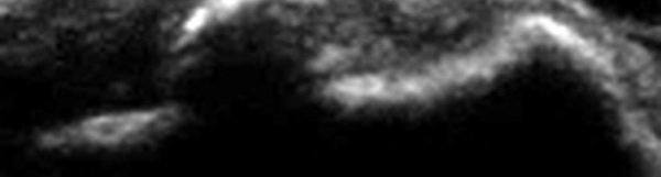 Calcification du tendon sub-scapulaire